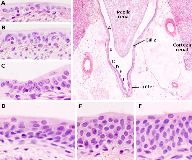 Pelvis renal