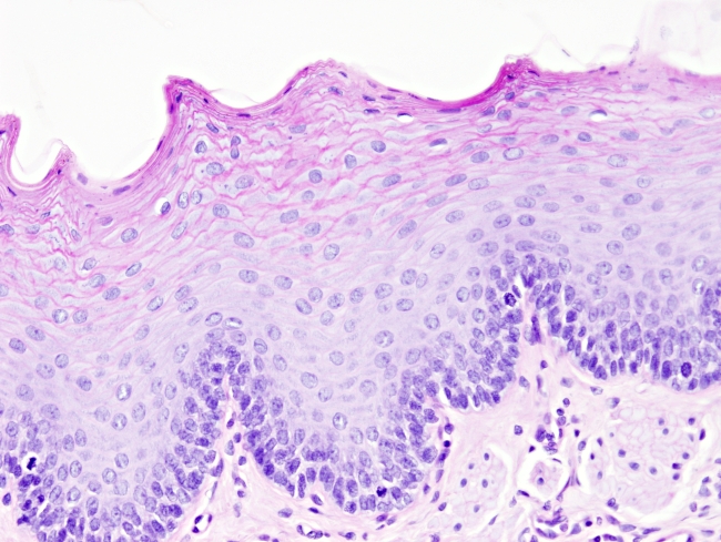 Epitelio plano estratificado