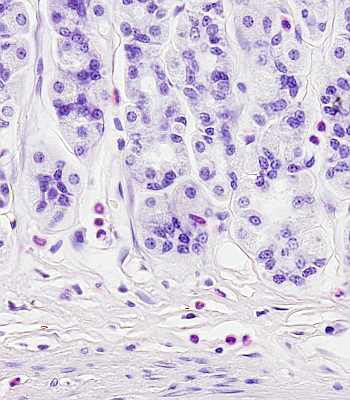 Eosinófilo en mucosa